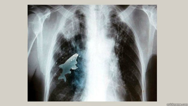 60 - 12 year old boy choked in the river water and inhaled a goldfish, the x-ray result....
