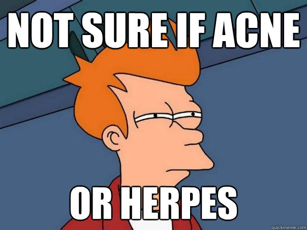 Acne Herpes
